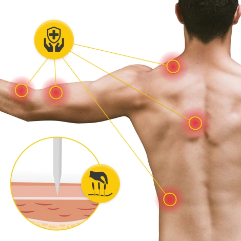 Igły do akupunktury z prowadnicą 100 szt. 0,3 x 60 mm